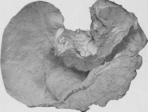 Cylinder celled carcinoma of the pylorus
