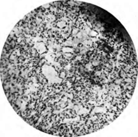 Histology of lymphangioendothelioma