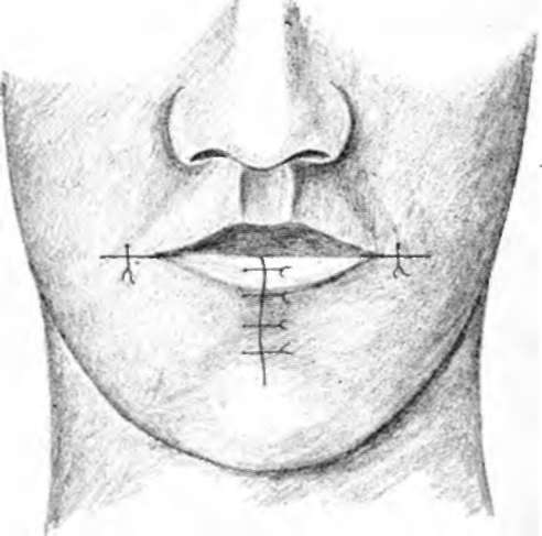 common method of repairing a defect caused by the excision of a V shaped piece of the lip