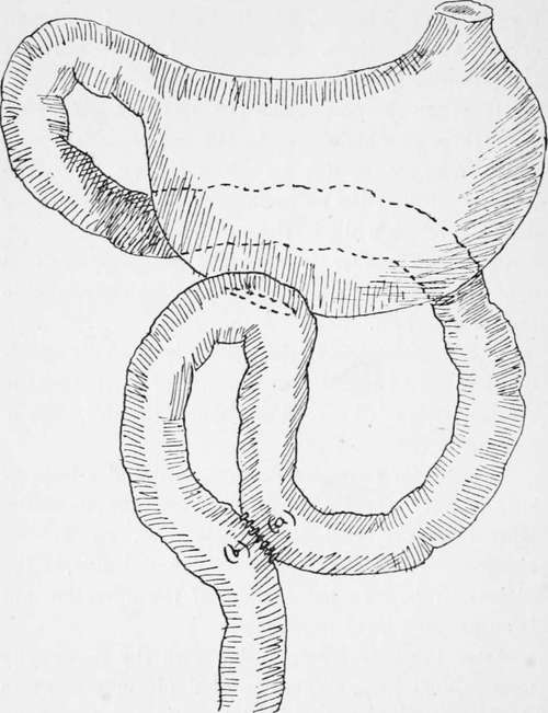 Entero Anastomosis Of The Jejunal Loop 36
