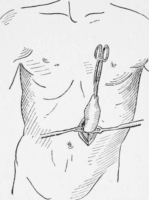 Gastrostomy France's Method