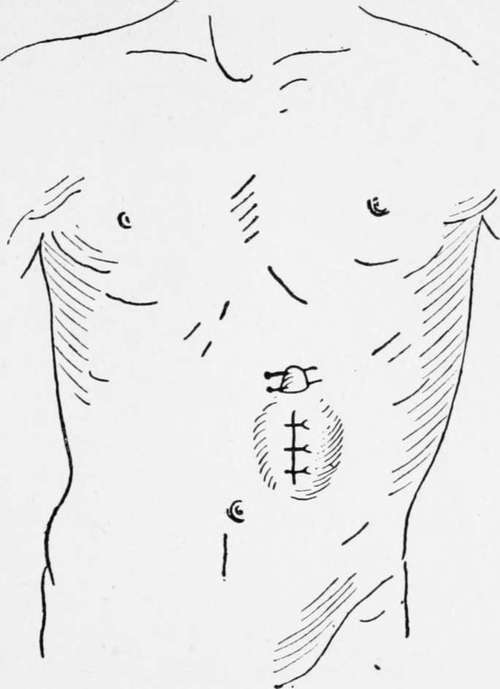Gastrostomy Franck's Method