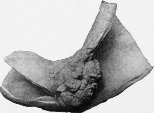 Polypus Near Pylorus, Which Caused Death By Vomiting. The Patient Was A Woman Aged Ninety Two.