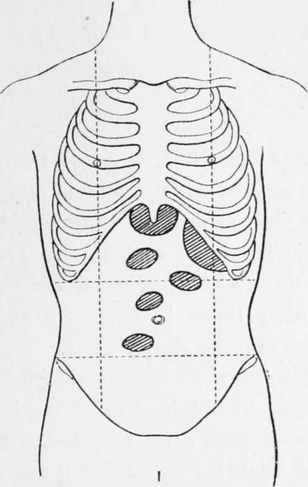 Various Positions In Which Tumour May Be Felt In Cancer Of The Stomach.