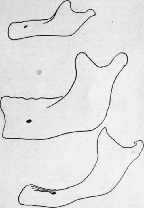 Types of jaws from a child