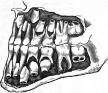 Temporary and Permanent Teeth in the jaws of a child six years old.