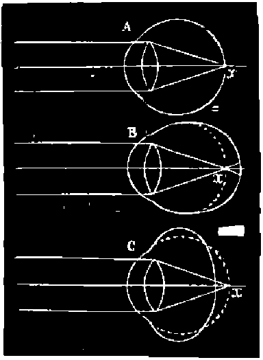 Diagram illustrating the path of parallel rays after entering an emmetropic.