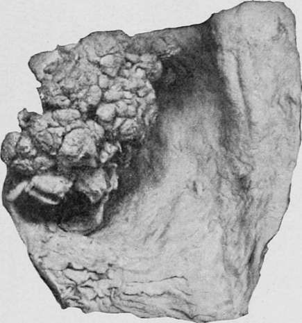 Papilloma of the pylorus