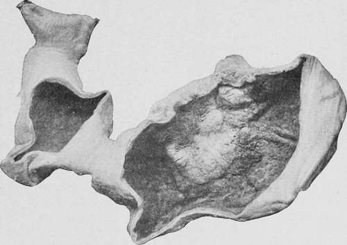 Scirrhous carcinoma of the cardiac orifice