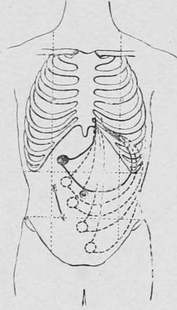 Showing the downward displacement of a pyloric tumour