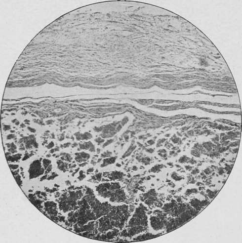 round cell infiltration of the submucosa