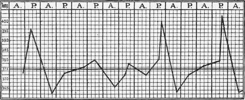 Irregular Fever With Predominating Tertian Type