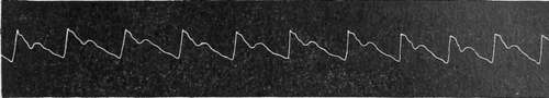 Pulse Curve Op A Double Tertian During Apyrexia