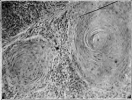 Epithelial pearls In a squamous celled cancer