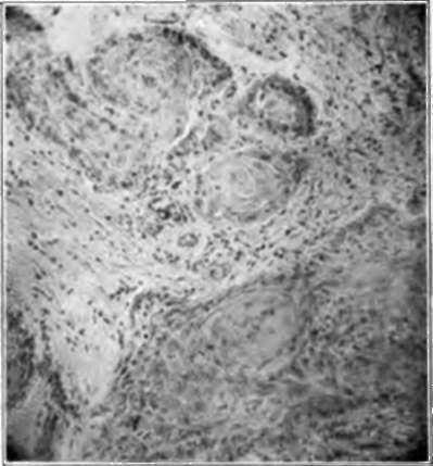 High power photomicrograph of prickle celled cancer