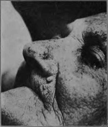 a flat basal celled carcinoma of the nose