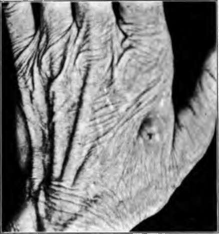 basal celled carcinoma of the hand