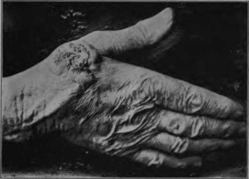 large basal celled cancer of the hand