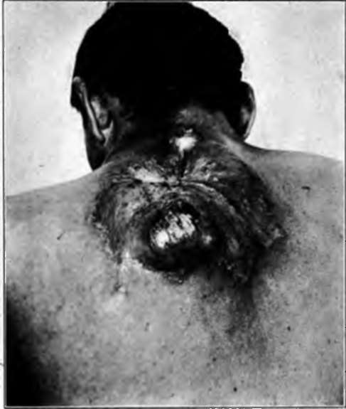 pigmented mole become malignant