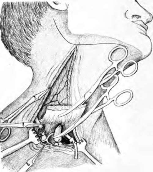 subcutaneous tissue have been incised, jugular veins ligated and cut, carotid artery is clamped