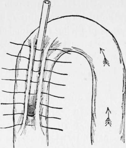 A Method Of Performing Jejunostomy