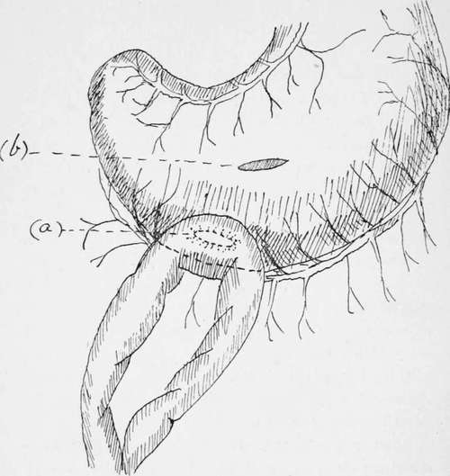 Anterior Gastrojejunostomy Showing The Correct Position (A) And The Incorrect Position (B) For The Anastomosis.