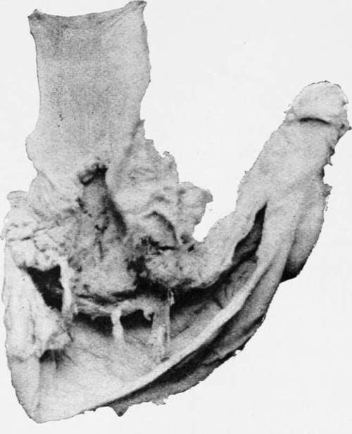 Cancer Of Cardiac Orifice Of The Stomach.