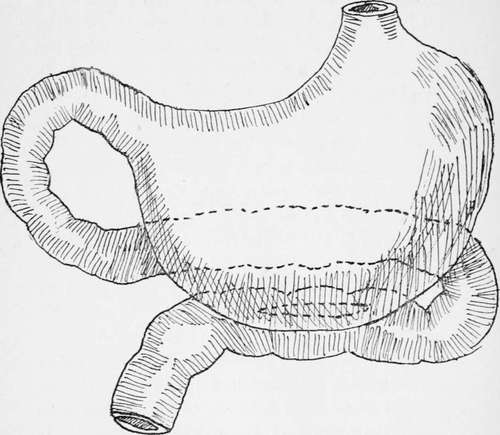 Gastrojejunostomy Showing The Relation Of The Jejunum To The Stomach After The Anastomosis Has Been Effected.