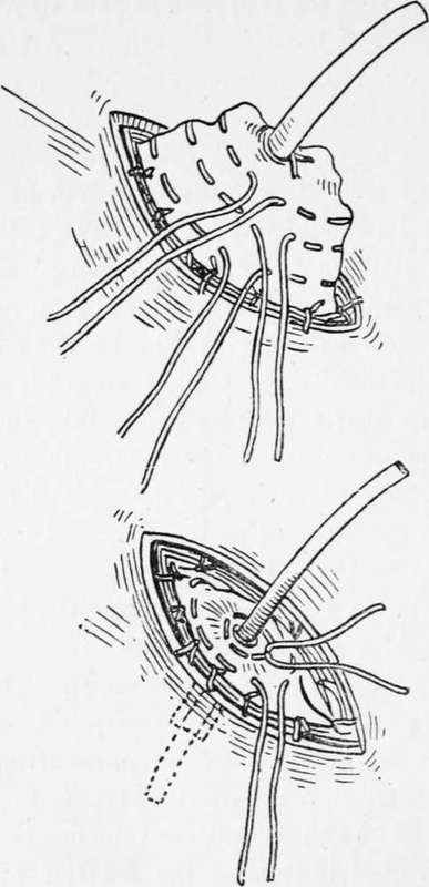 Gastrostomy Senn's Method