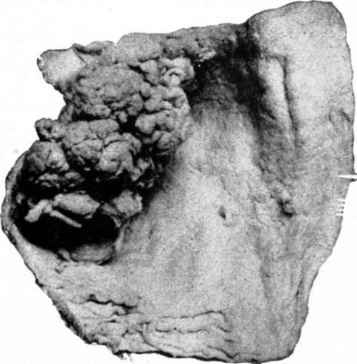 Polypus Near Pylorus Which Caused Fatal Intussusception Of Duodenum In A Man Aged Twenty One.