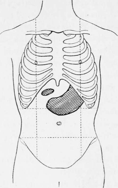 Various Positions In Which Tumour May Be Felt In Cancer Of The Stomach.