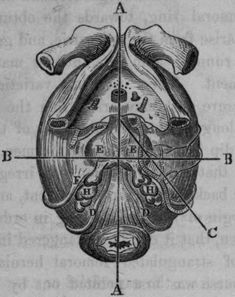 Abnormal Course of the Left Internal Pudic Artery