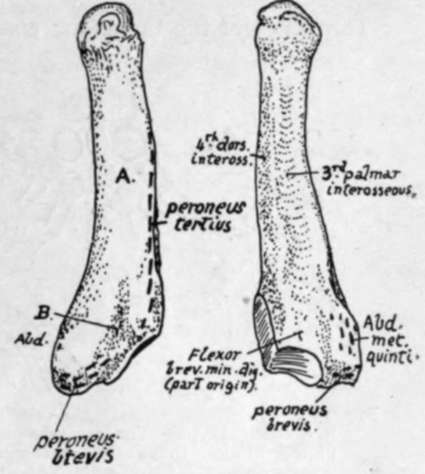 Left fifth metatarsal