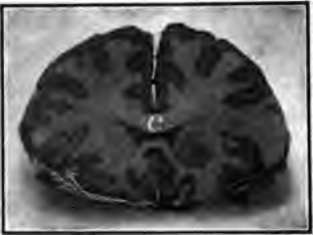 A slice across the brain to show white and gray matter.