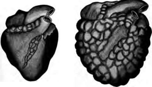 Healthy heart on the left and heart of a beer drinker on the right.
