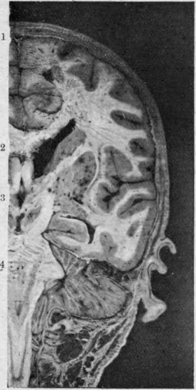 Coronal Head Section passing through portion of the Spinal Canal.